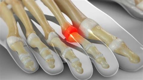 What Are The Symptoms Of Metatarsophalangeal Joint Dislocation? - Targetey