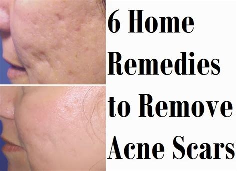 6 Home Remedies to Remove Acne Scars - SkinnyZine