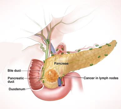 Neuroendocrine Tumor Treatment in Bangalore | Pancreatic Neuroendocrine Tumors Treatment in ...