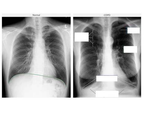 CXR: Normal VS COPD — Printable Worksheet