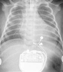 Epicardial pacing wires - Questions and Answers in MRI