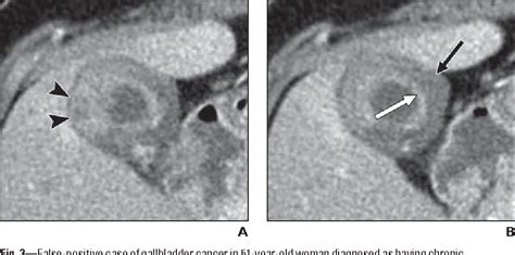 Figure 3 from Analysis of enhancement pattern of flat gallbladder wall thickening on MDCT to ...