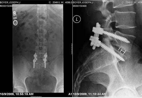 You are offered a minimally-invasive spinal surgery? Continue reading before scheduling your ...