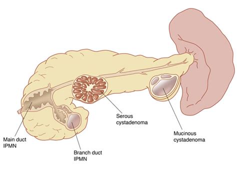 Pseudocysts | Stanford Health Care