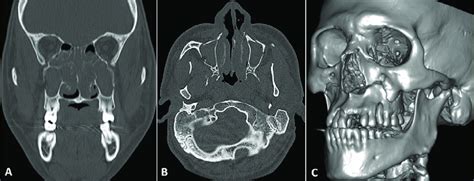 Case 1 -Computed tomography scan showing the Le Fort I fracture: (A ...