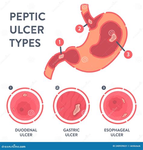 Types Of Peptic Ulcer Stomach Disease Infographics Cartoon Vector ...