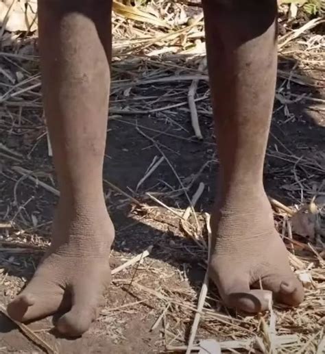 Mystery behind 'Ostrich people' tribe whose deformed feet 'evolved for ...