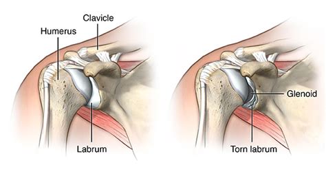 Subluxation shoulder joint - Blog | Axis Orthopedic Hospital : Blog | Axis Orthopedic Hospital