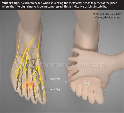 Espectáculo Explícito Sofocante neuroma de morton metatarsalgia Distinción subtítulo variable