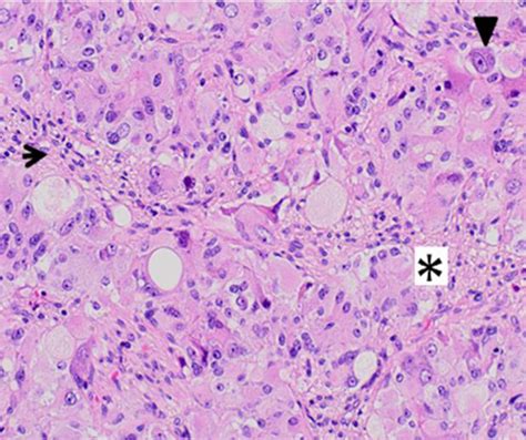 -Ganglyocityc paraganglioma. High power field of the 3 neoplastic... | Download Scientific Diagram