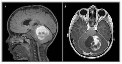 Juvenile pilocytic astrocytoma, WHO 1: (A) sagittal T2 FLAIR with ...