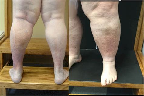 Chronic Venous Insufficiency Vein Disorders. Vein Specialists of Carolinas