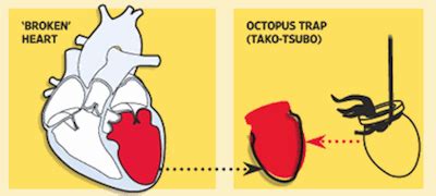 Takotsubo Cardiomyopathy: The Octopus Trap