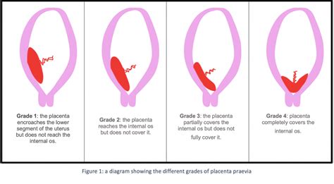 Antepartum Haemorrhage (APH) | Abruption, Vasa Praevia, Placenta Praevia | Geeky Medics