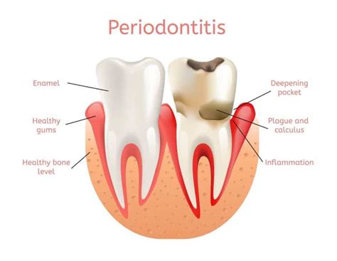 Bleeding Gum Dentist: 3 Stages of Periodontal Disease - Know The Signs