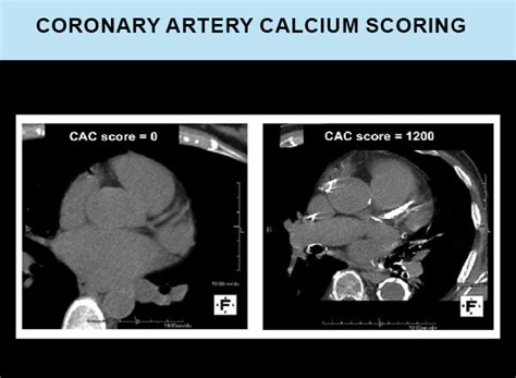 CT Coronary Artery Calcium Scoring - Trust Multispeciality Hospitals