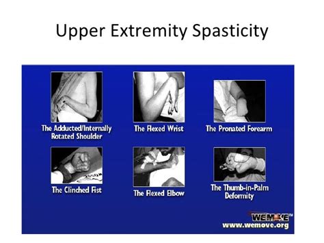 Spasticity After Stroke