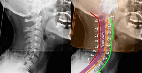 Healthy Cervical Spine Xray