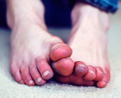 Community Foot Specialists - Podiatrists in Springfield and Dayton, Ohio: Frostbite, Prevention ...