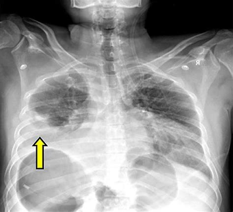 Chest X-ray reveals a raised right hemidiaphragm with a homogeneous... | Download Scientific Diagram