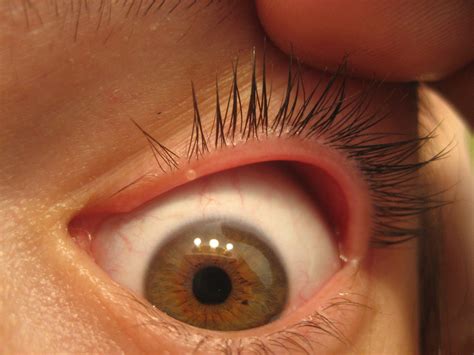 Tiny blister on inner eyelid? : r/optometry