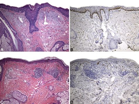 Melanoma in situ - Journal of the American Academy of Dermatology