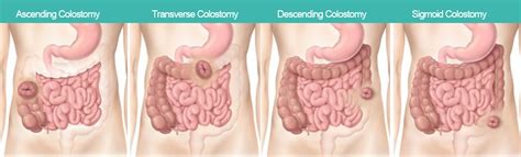 Do You Know 3 Primary Types Of Ostomy Surgery?