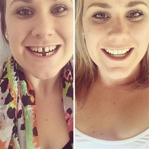 10+ Incredible Before & After Transformations Of People Who Wore Braces | Bored Panda