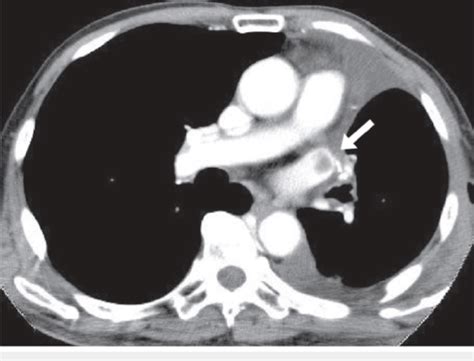 CT scan of the chest with IV contrast A thrombus (white arrow) in the... | Download Scientific ...