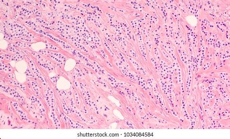 Invasive Lobular Carcinoma Photos and Images & Pictures | Shutterstock