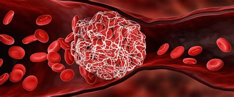 What to Know About Blood Clots and COVID-19