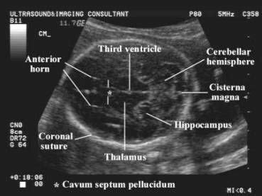 Fetal Anomalies Associated With Breech Presentation | Medical ultrasound, Obstetric ultrasound ...