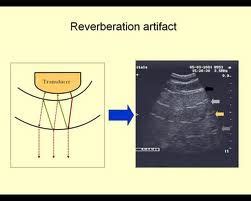 reverberation artifact - Google Search | Physics | Pinterest | Ultrasound