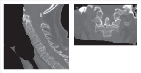 Figure 1 from Halo vest treatment of the upper cervical spine fractures ...