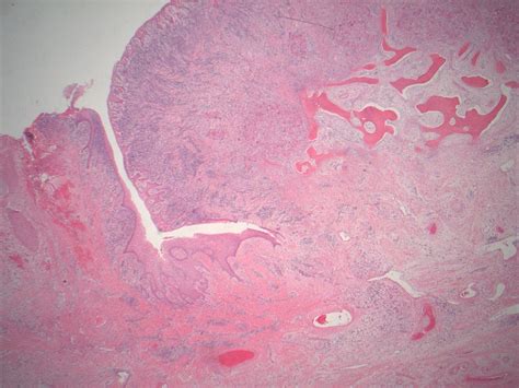 Pathology Outlines - Peripheral giant cell granuloma