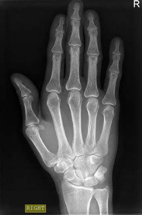 Spiral Fracture In Hand