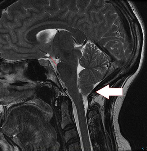 Cureus | Spontaneous Intracranial Hypotension Presenting as a "Pseudo-Chiari 1"