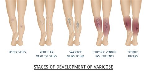 Varicose Veins: A Detailed Guide Answering All Your Questions