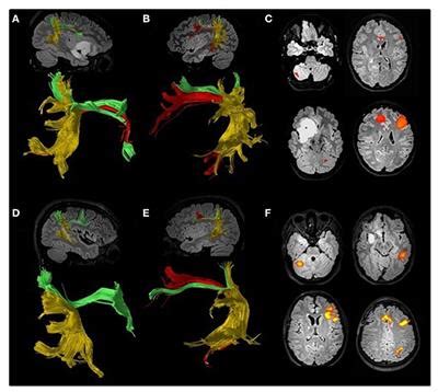 Frontiers | Perspectives on (A)symmetry of Arcuate Fasciculus. A Short ...