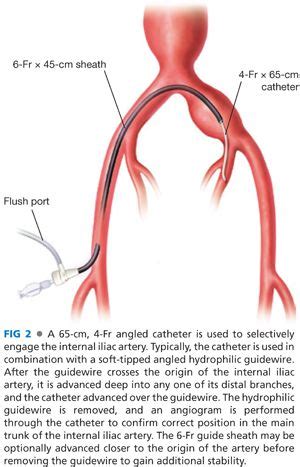 Advanced Aneurysm Management Techniques: Management of Internal Iliac ...