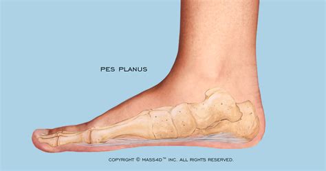 Pes Planus | MASS4D® Custom Orthotics and Insoles