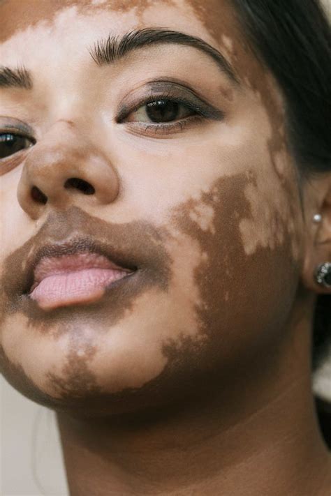 35 Beautiful Women With Vitiligo Shot By A Photographer Who Has The Same Condition | Bored Panda