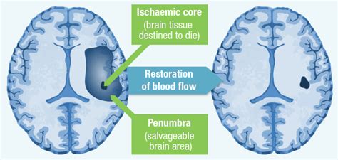 Emergency Room Treatment for Patients With Stroke | Free Essay Example