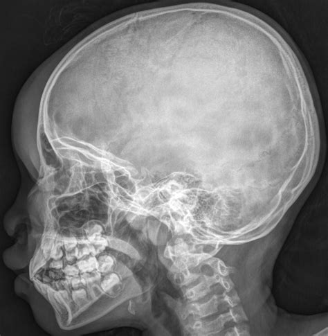 X Ray Cranium Indications soft Tissue Sweling - Radiology Imaging