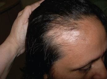 Patterned hair loss with bi-temporal recession in a patient with PCOS... | Download Scientific ...