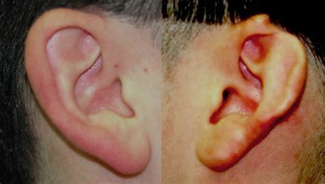 Plastic Surgery Case Study - Ear Reconstruction with Skin Flap and Rolled ePTFE Implant ...