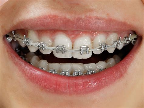 Can you whiten your teeth with braces - Dr Chauvin