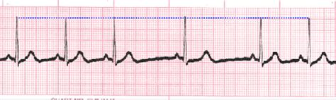 Sinus Rhythms Reference Page - EKG.Academy