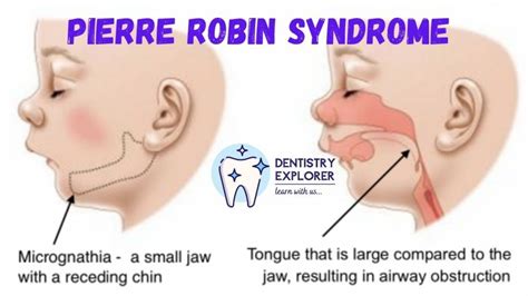 Pierre Robin Syndrome - Turkey Istanbul Medical