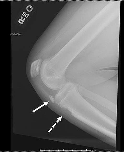 Tibial Tubercle Xray